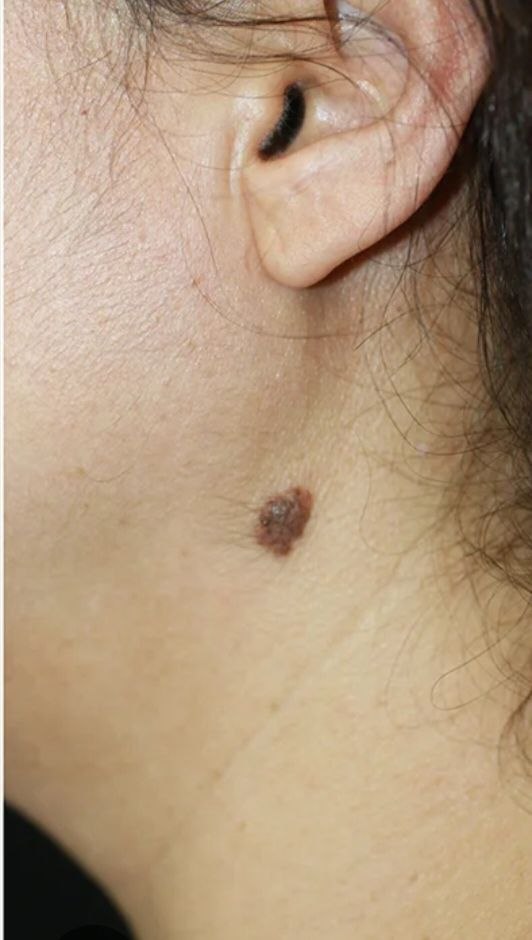 Before treatment result