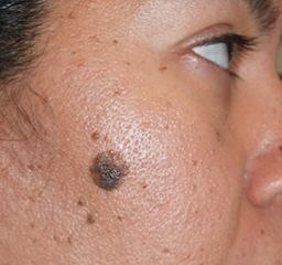 After treatment result