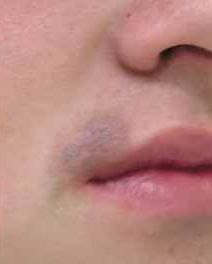 Before treatment result