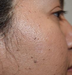 After treatment result