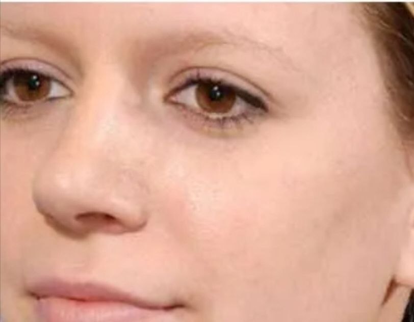 After treatment result
