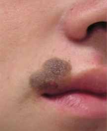 Before treatment result