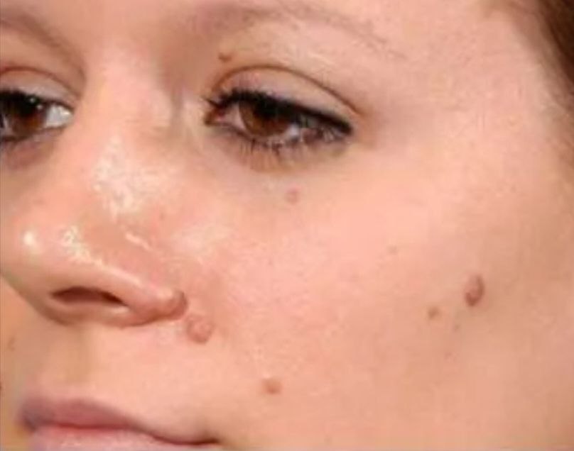 After treatment result